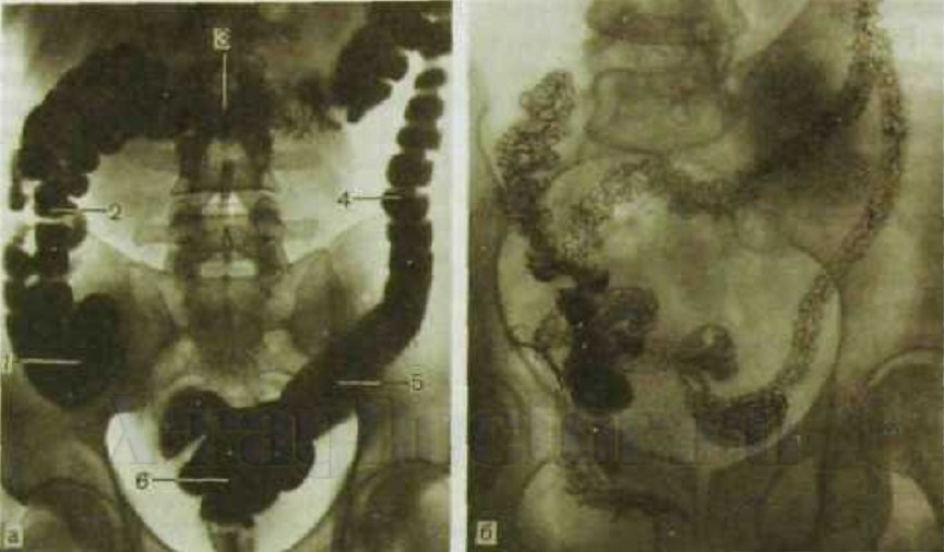 рентгенография кишечника (толстая кишка)